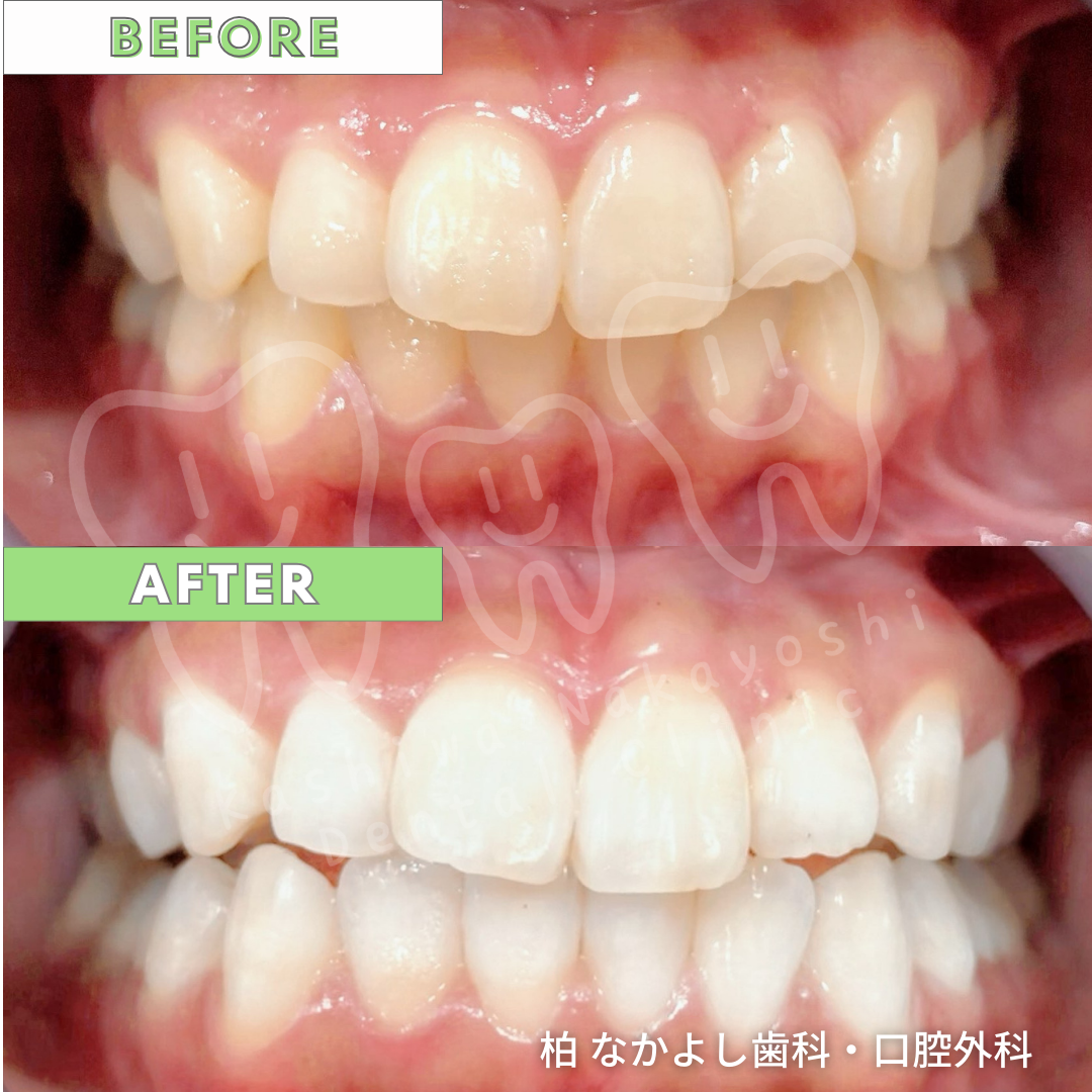 ホワイトニング　症例写真